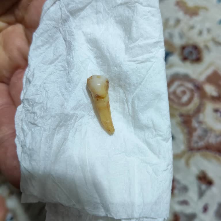 Dt. Şerif Tosun Kanal Tedavisi Hatası Sonucu Malzeme Kalması Ve Şiddetli Ağrı