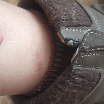 Deichmann Çizmeleri Bacaklarımda Derin Yaralar Oluşturdu Ve Mağaza Cevap Vermedi