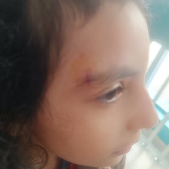 Lacoste Gözlüğünün Kırılması Çocuğumun Yaralanmasına Neden Oldu