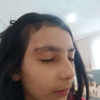 Lacoste Gözlüğünün Kırılması Çocuğumun Yaralanmasına Neden Oldu