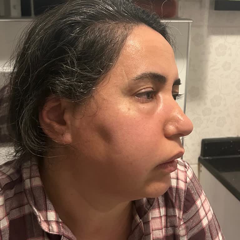 Özel Ümran Diş Sağlığı Merkezi İltihaplı Dişin Üzerine Doğrudan Dolgu Yapıldı