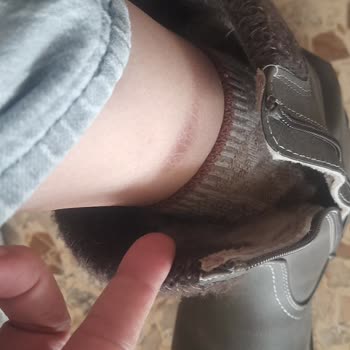 Deichmann Easy Street Boots Caused Leg Injuries