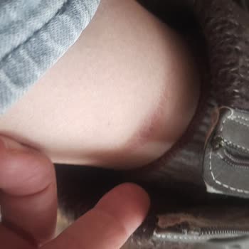 Deichmann Easy Street Boots Caused Leg Injuries
