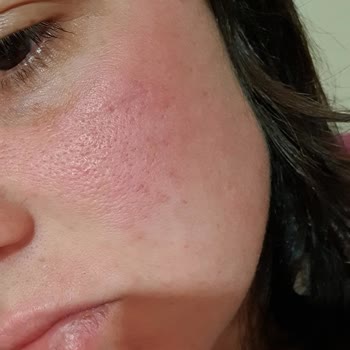 Monodoks Yüzünden Yandım