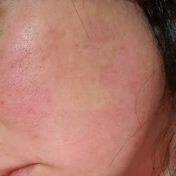 Monodoks Yüzünden Yandım