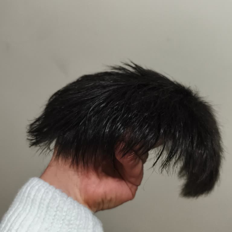 Mehmet Ogün Saç Protez Hem Ödediğim Paradan Oldum Hem de Psikolojik Olarak Yıprandım