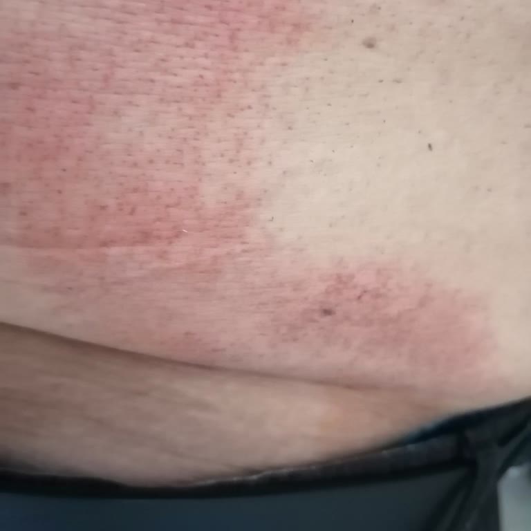 Epify Tüy Dökücü Ürününün Cilt Yanığı Ve İade Talebi