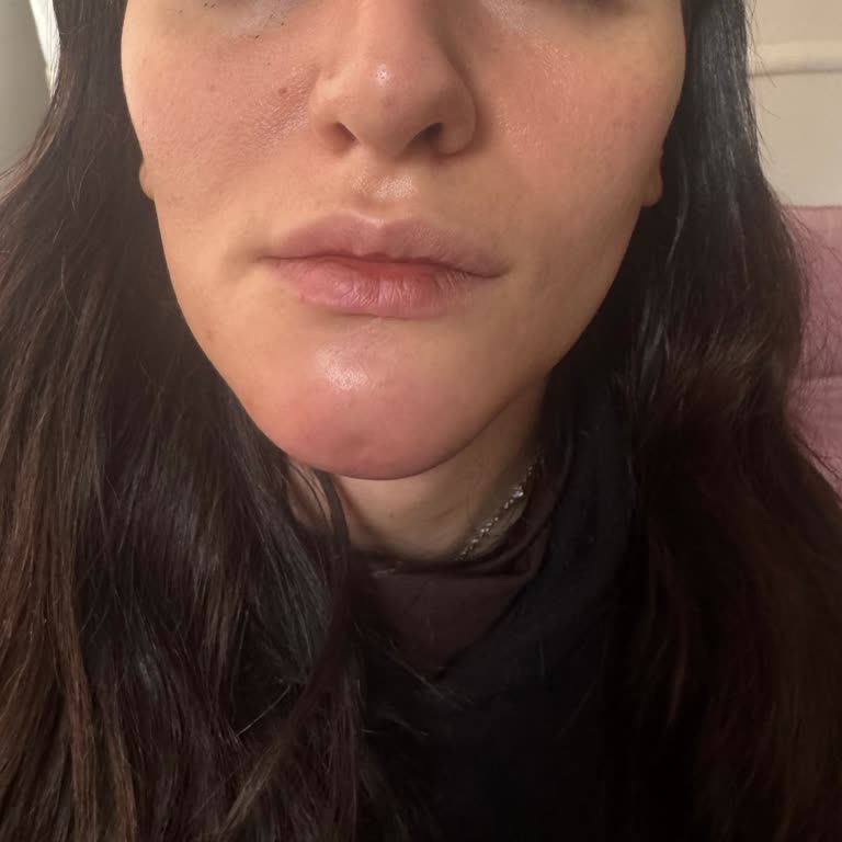 22.500 TL Dolgu Ücretinin İadesi Ve Kalıcı Yüz Asimetrisinden Şikayet