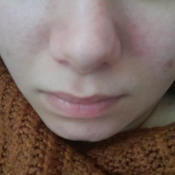 Rinoplasti Sonrası Burnumda Eğrilik Ve Söz Verilen Ücretsiz Düzeltmenin İptali