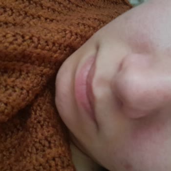 Rinoplasti Sonrası Burnumda Eğrilik Ve Söz Verilen Ücretsiz Düzeltmenin İptali