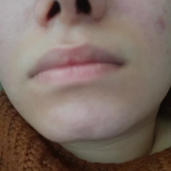 Rinoplasti Sonrası Burnumda Eğrilik Ve Söz Verilen Ücretsiz Düzeltmenin İptali