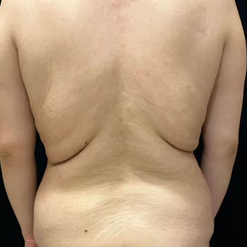 Ameliyat Öncesi Bilgilendirme Eksikliği Ve Sonrası Sarkma Ve BBL Görüntüsü Şikayeti