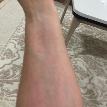Bioderma Atoderm Creme Ultra Yeni Üründe Şiddetli Alerjik Reaksiyon Ve Kaşıntı