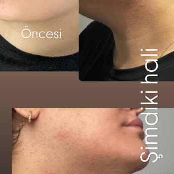 Siyah Nokta Kil Maskesi Sonrası Ciltte Yaygın Sivilce Ve Tahriş Şikayeti