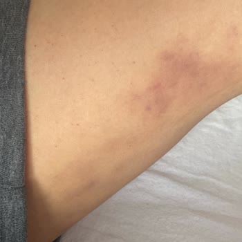 Şiddetli Bacak Yanıkları Ve Umursamaz Klinik İlgisi
