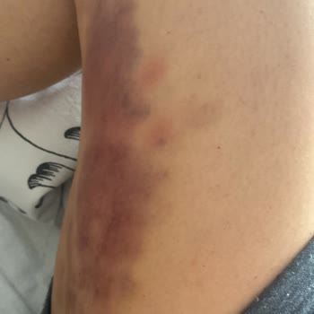 Şiddetli Bacak Yanıkları Ve Umursamaz Klinik İlgisi