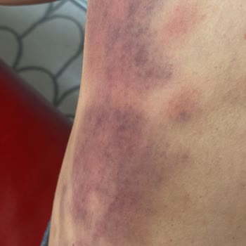 Şiddetli Bacak Yanıkları Ve Umursamaz Klinik İlgisi