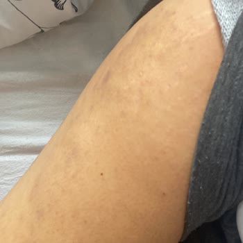 Şiddetli Bacak Yanıkları Ve Umursamaz Klinik İlgisi