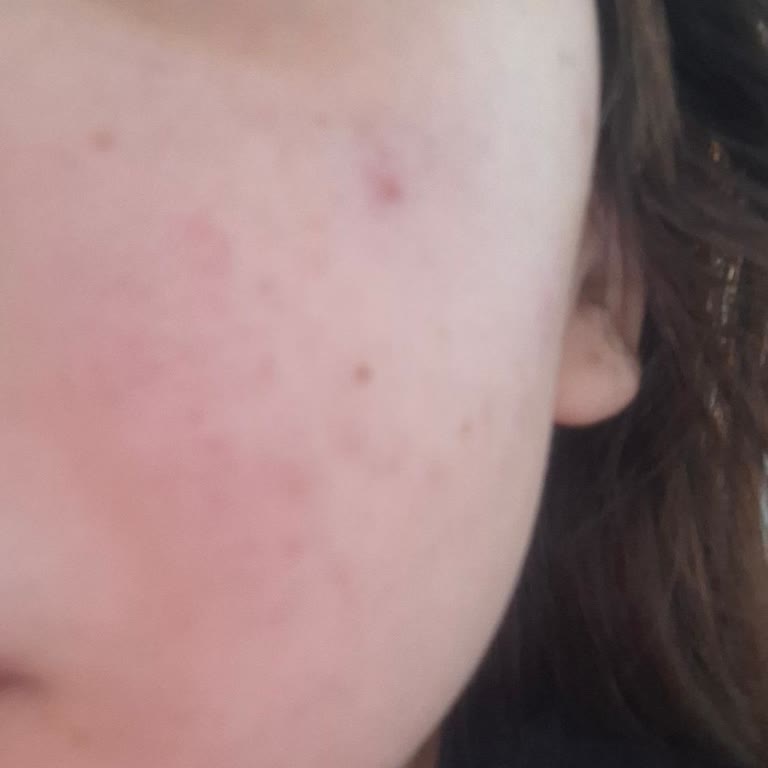 Yanlış Ürün Tavsiyesi Cildimde İltihaba Neden Oldu, Ücret İadesi Talebi