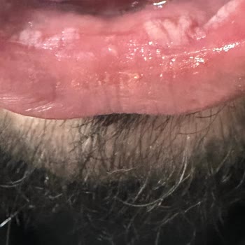 Sensodyne Diş Macunu Kullanımından Sonra Ağız İçinde Yara Ve Dudak Soyulması