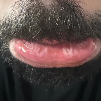 Sensodyne Diş Macunu Kullanımından Sonra Ağız İçinde Yara Ve Dudak Soyulması