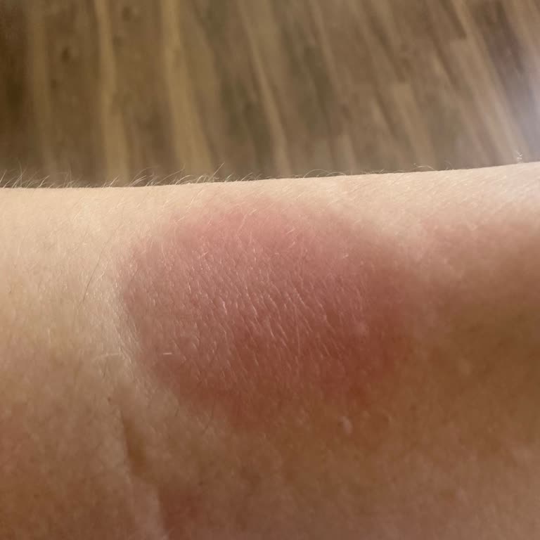 Michael Kors MK4843 Saatinde Alerjik Reaksiyon Ve İade Talebi