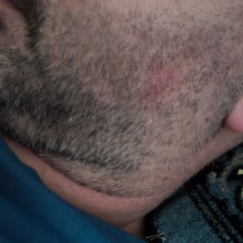 Collagen Life Pro Tabletinin Yan Etkileri Yüzde Sivilce Ve Karında Şişkinlik, Ücret İadesi Ve Denetim Talebi