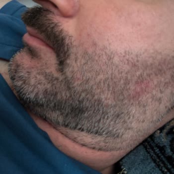 Collagen Life Pro Tabletinin Yan Etkileri Yüzde Sivilce Ve Karında Şişkinlik, Ücret İadesi Ve Denetim Talebi