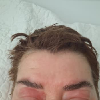 Dexyane Med Palpebral Caused Severe Eyelid Swelling After First Use