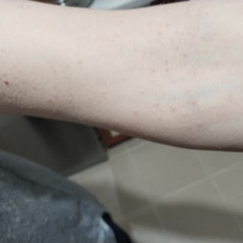 Bingo Şampuanı Anne Cildinde Alerjik Reaksiyon Oluşturdu Ve Ürünün Geri Çağrılması Gerekiyor