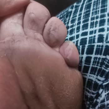 Ayak Sağlığına Verdiği Zarar Ve Rahatsızlık Nedeniyle Tüm Ayakkabılar İçin İade Talebi