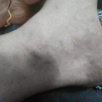 Ayak Sağlığına Verdiği Zarar Ve Rahatsızlık Nedeniyle Tüm Ayakkabılar İçin İade Talebi
