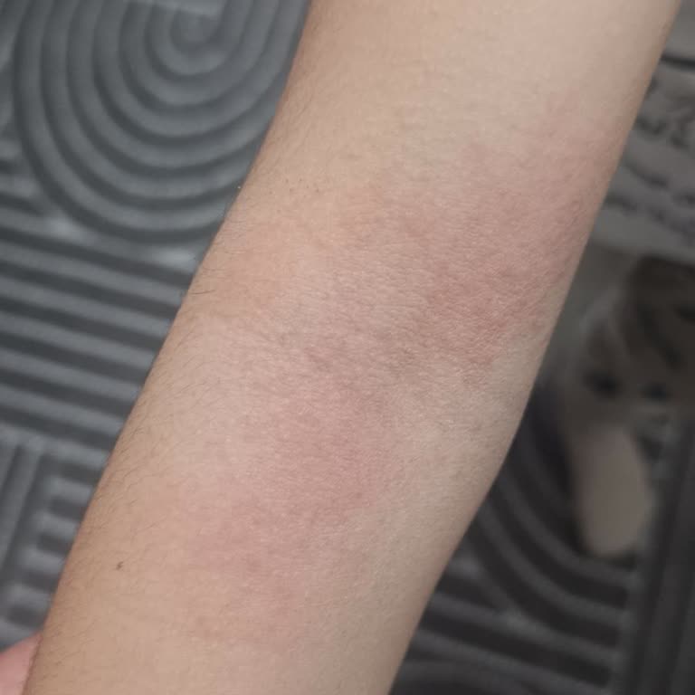 Xabion Losyonu Çocuğumun Cildinde Şiddetli Alerjik Reaksiyon Ve Acil Müdahale Gerektirdi