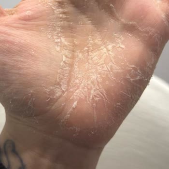 Dove Caring Sıvı Sabunun Cilt Kuruluğu Ve Yanıltıcı Nemlendirme İddiası