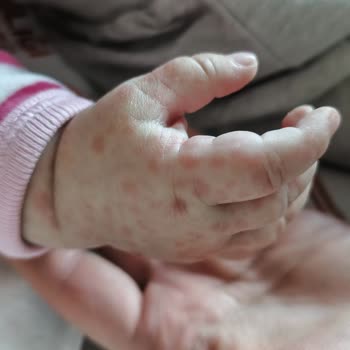 6 Aylık Bebekte Ağır Koku Ve Alerjik Reaksiyonla Hastaneye Yönlendiren Bebelac 2