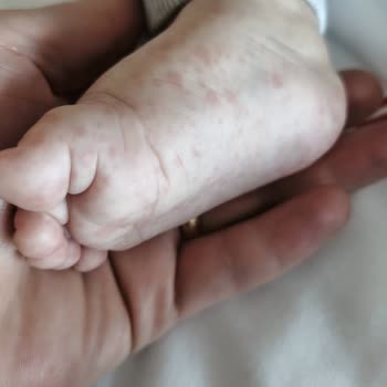 6 Aylık Bebekte Ağır Koku Ve Alerjik Reaksiyonla Hastaneye Yönlendiren Bebelac 2