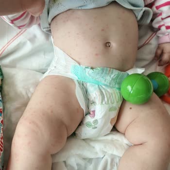 6 Aylık Bebekte Ağır Koku Ve Alerjik Reaksiyonla Hastaneye Yönlendiren Bebelac 2