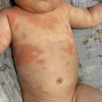 Bebekte Şiddetli Egzama Ve Yanık Reaksiyonuna Neden Olan Mustela Ürünleri