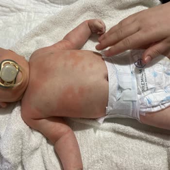 Bebekte Şiddetli Egzama Ve Yanık Reaksiyonuna Neden Olan Mustela Ürünleri