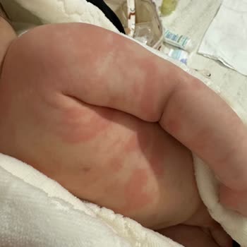 Bebekte Şiddetli Egzama Ve Yanık Reaksiyonuna Neden Olan Mustela Ürünleri