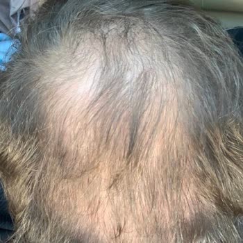 Estetic Hair Center Saç Ekiminde Yanıltıcı Uygulama Ve 55 Bin Tl Mağduriyeti