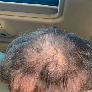 Estetic Hair Center Saç Ekiminde Yanıltıcı Uygulama Ve 55 Bin Tl Mağduriyeti