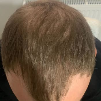 Estetic Hair Center Saç Ekiminde Yanıltıcı Uygulama Ve 55 Bin Tl Mağduriyeti