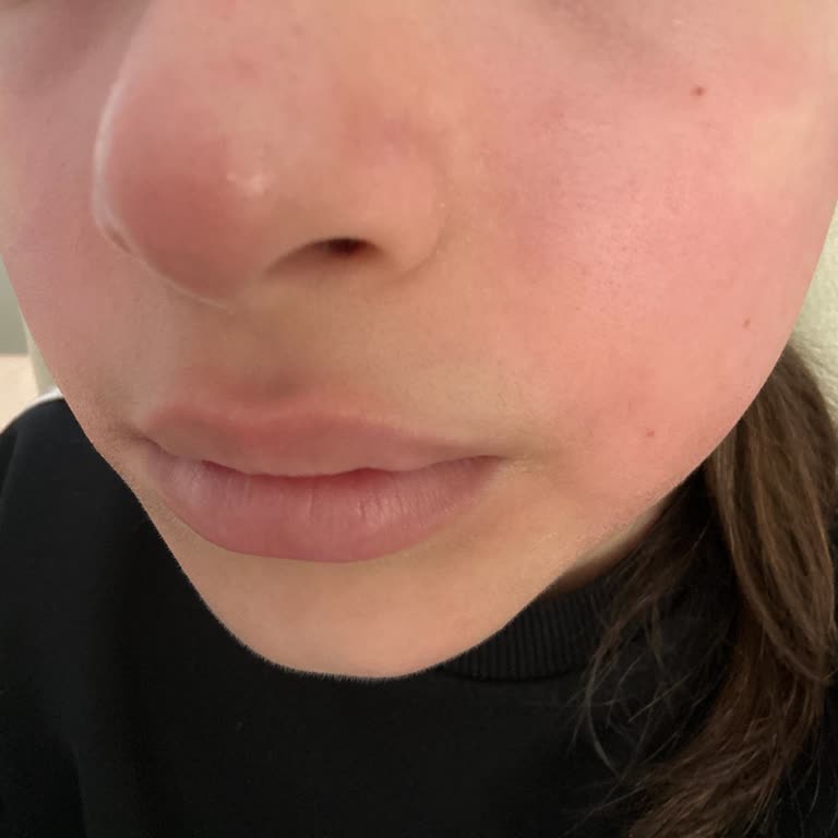 Nivea Yüz Temizleme Köpüğünde Kızarıklık Ve İade