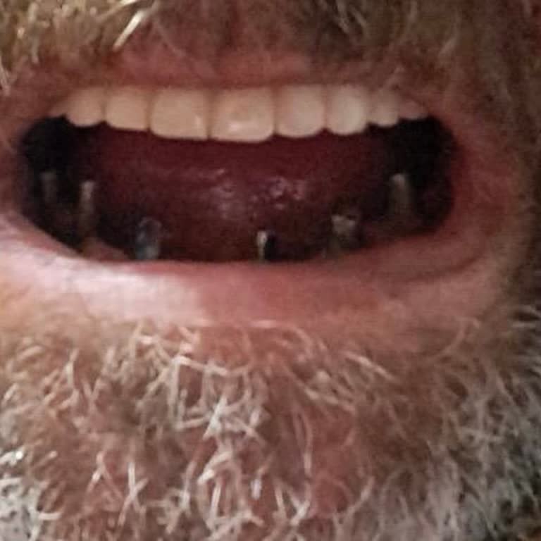 Özel Bağcılar Diş Sağlığı Polikliniği'nde 160 Bin TL'lik İmplantın Düşmesi