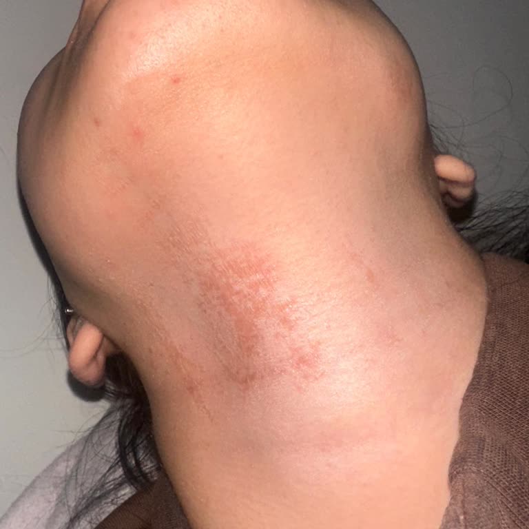 Vi-Vet Normal Cilt İçin Olan Ağda Ürününde Şiddetli Yanma ve Kızarıklık