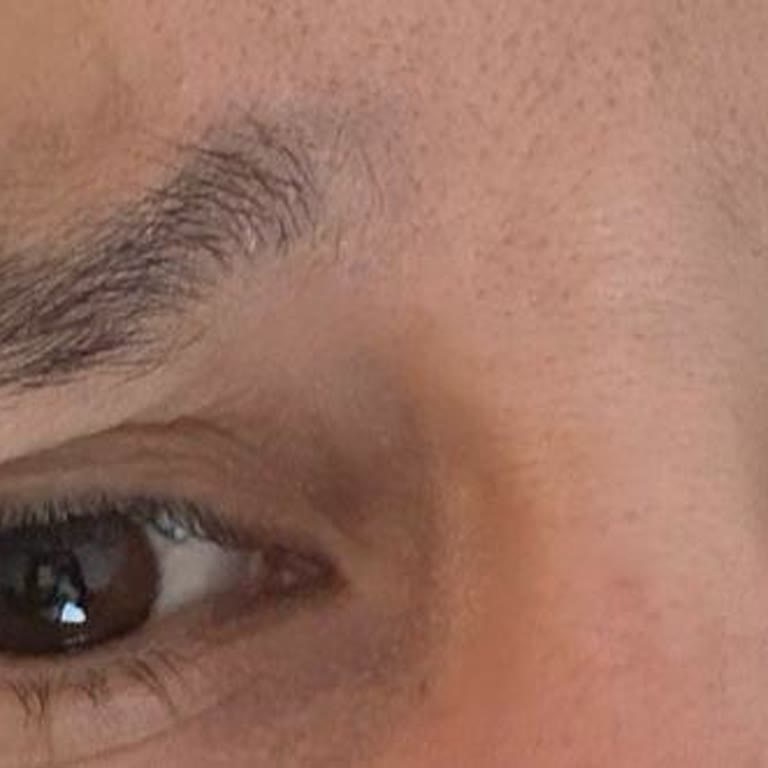 Botoks Sonrası Kaş Düşüklüğü Ve İlgisiz İletişim Nedeniyle 3600 TL İade Talebi