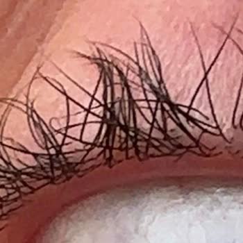 Kirpik Lifting Sonrası Aşırı Yükseliş Ve Kalıcı Hasar