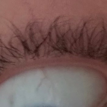 Kirpik Lifting Sonrası Aşırı Yükseliş Ve Kalıcı Hasar