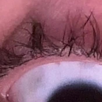 Kirpik Lifting Sonrası Aşırı Yükseliş Ve Kalıcı Hasar